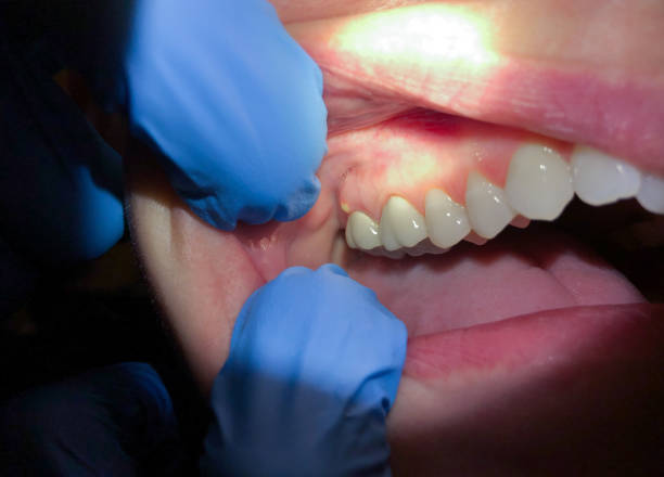 Best Emergency Denture Repair in Iota, LA